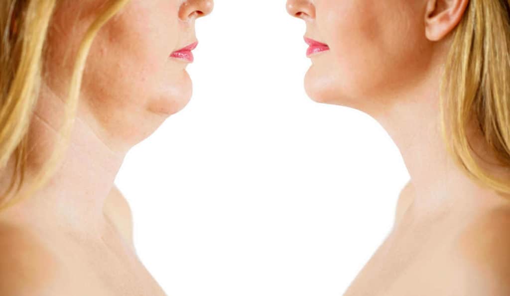 Double Chin treatment Edmonton before and after results