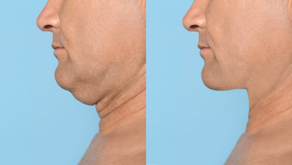 Which Non-Surgical Treatments Work Best for Jowls and Loose Skin Edmonton?