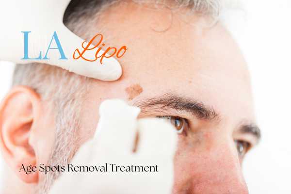 What Are the Most Effective Treatments for Age Spots Edmonton?