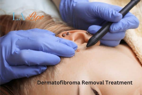 Dermatofibroma Removal Treatment Edmonton