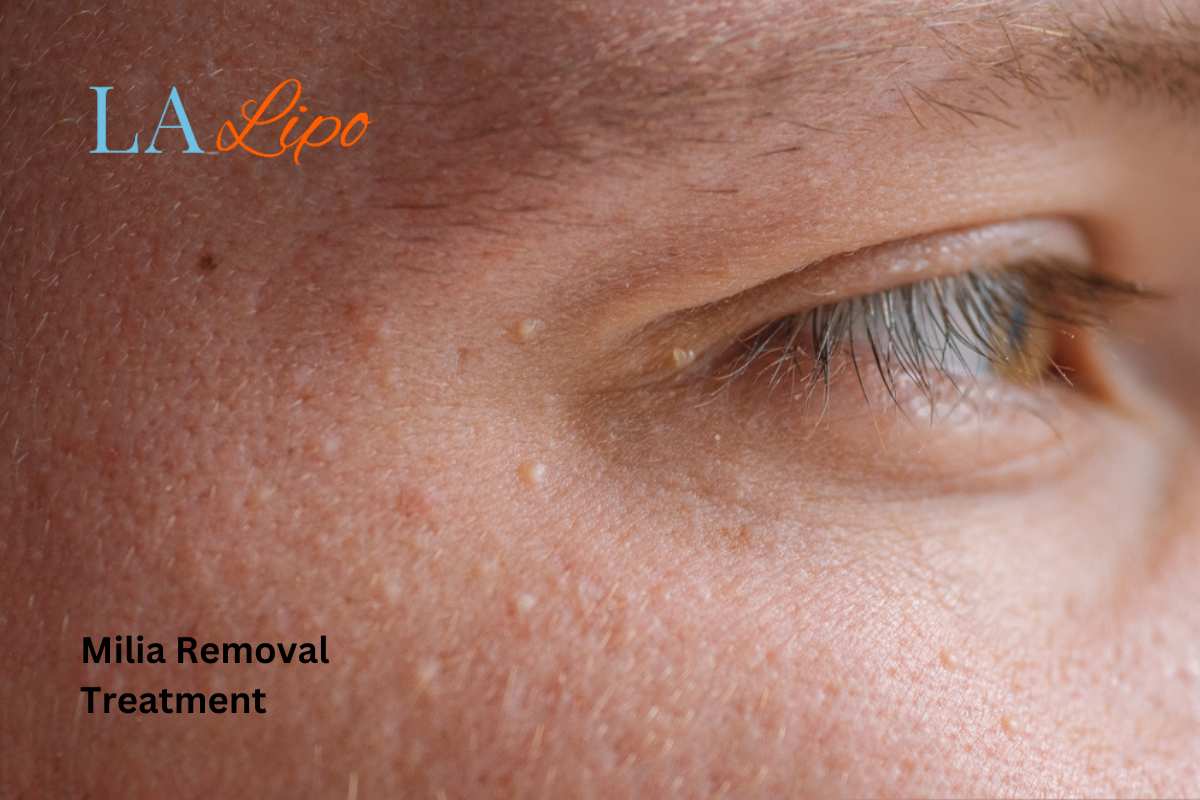 Cryopen Milia Removal: Is It the Easiest and Safest Option Edmonton?