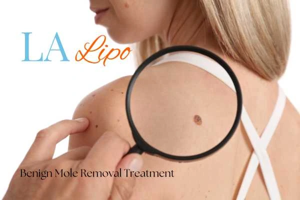 Woman having her inspection of blemish before mole removal Edmonton
