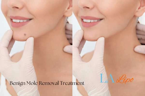 woman's before and after mole removal Edmonton results