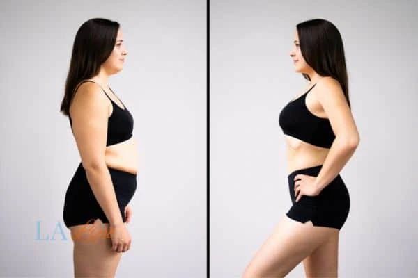 image of woman before and after results of LA-EMS Body Sculpting Edmonton to help treat Diastasis recti