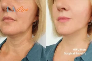 hi-fu for wrinkles Edmonton before and after results