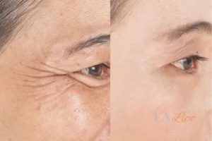 Before and after results of woman - HI-fu wrinkles reduction treatment Edmonton