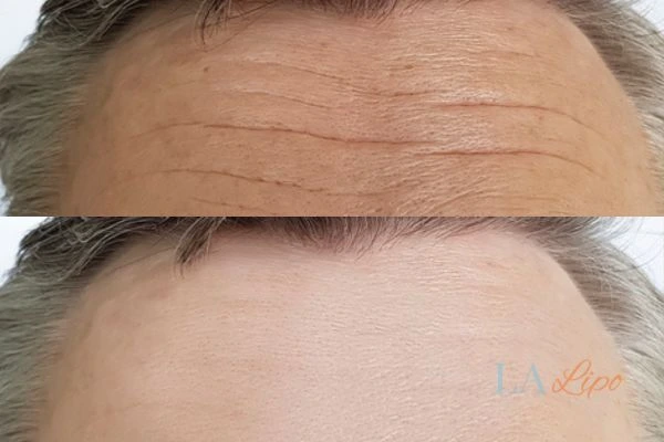 results of HIFU Edmonton on mans forehead to help reduce lines and wrinkles