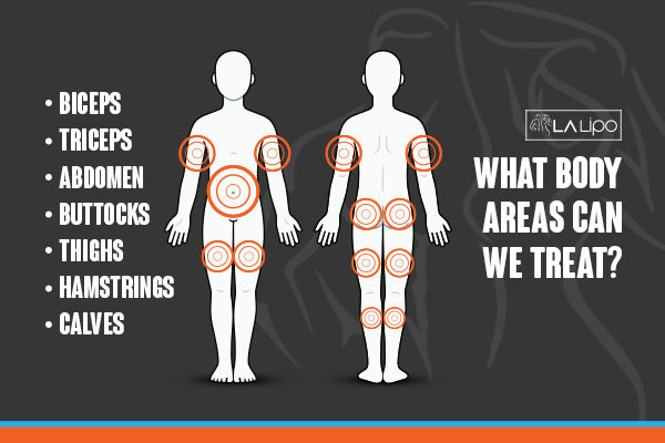 Graphic to show areas you can have LA-EMS Body Sculpting Edmonton treatment.