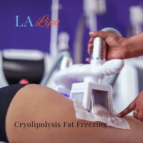fat freezing - Cryolipolysis Edmonton