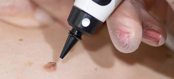 skin tag removal using cryopen Edmonton