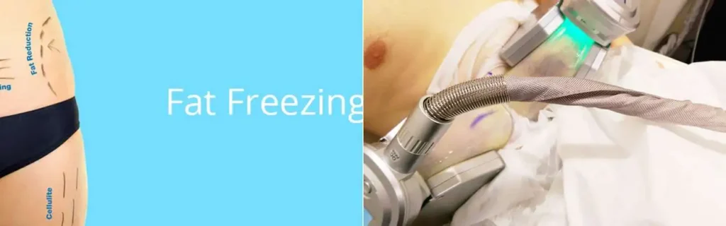 Fat freezing Edmonton on multiple areas of the body