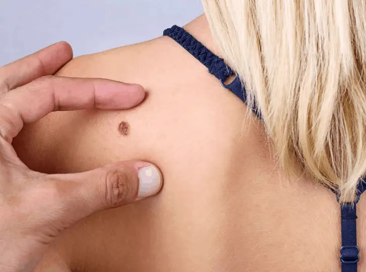 woman having mole removal Edmonton consultation before treatment.