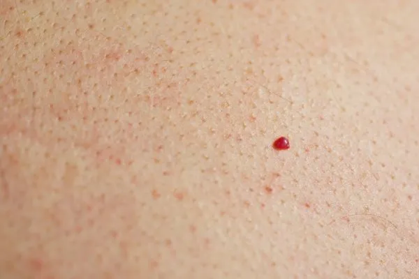 close up of a cherry angioma Edmonton