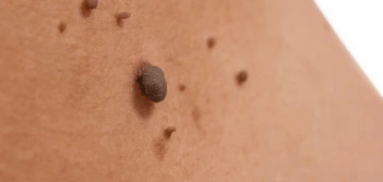 image of a skin tag Edmonton