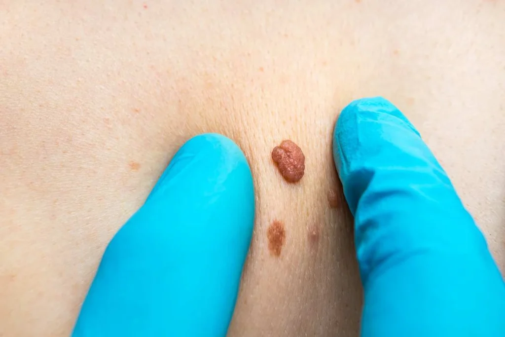 Consultant examining a skin tag Edmonton