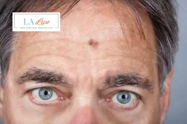 Solar Lentigo Removal Edmonton image of man with mark on his forehead