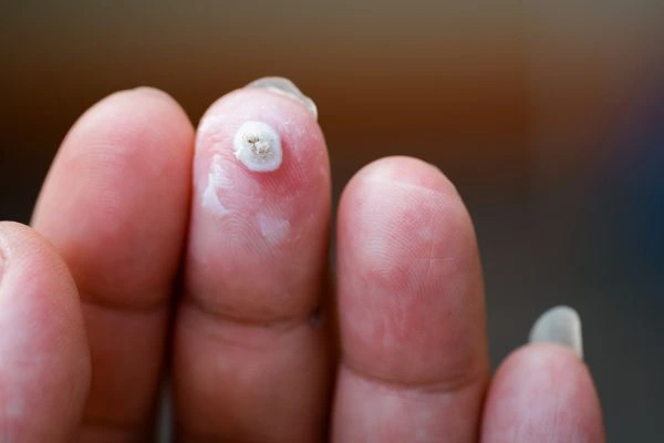 wart on person finger - cryotherapy to treat from LA LIPO Edmonton