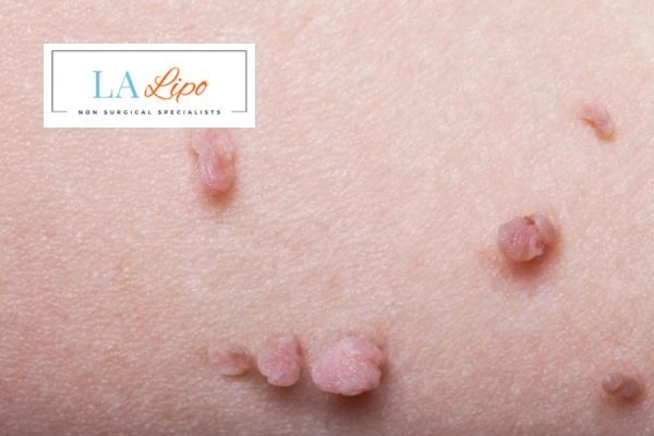 Does cryopen skin tag removal Edmonton hurt? Find out now call our team today!
