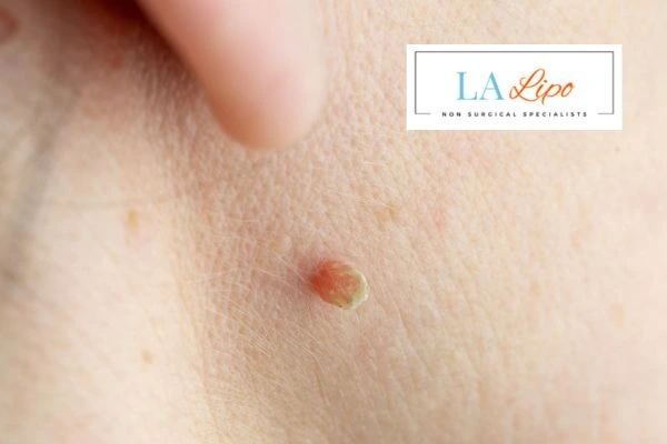 Book skin tag removal Edmonton today speak to our team now!