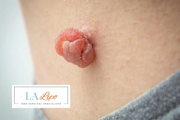 Interested in skin tag removal Edmonton? Concerned about the pain? Find out more today!