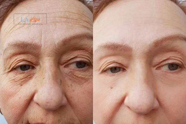 The powerful benefits of Morpheus8 Treatment Edmonton - Call Our team today!