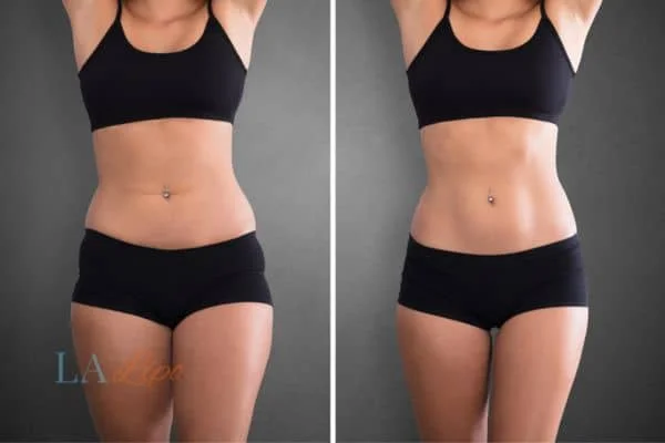 before and after results of non-surgical treatment to help a woman's body image and mental health Edmonton