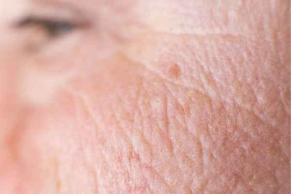 close up picture of a woman's face showing an age spot Edmonton