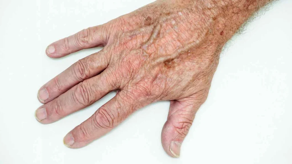 Male hand showing age spot Edmonton