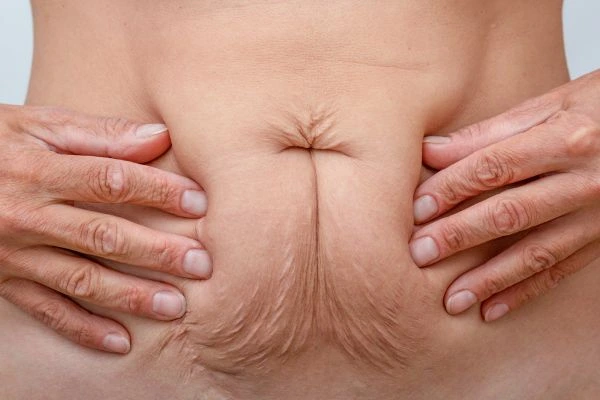 Image of a woman's stomach with loose skin - example of skin tightening Edmonton options