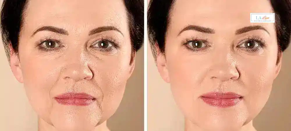 How Long Does It Take to See Results and How Long Do They Last Edmonton?