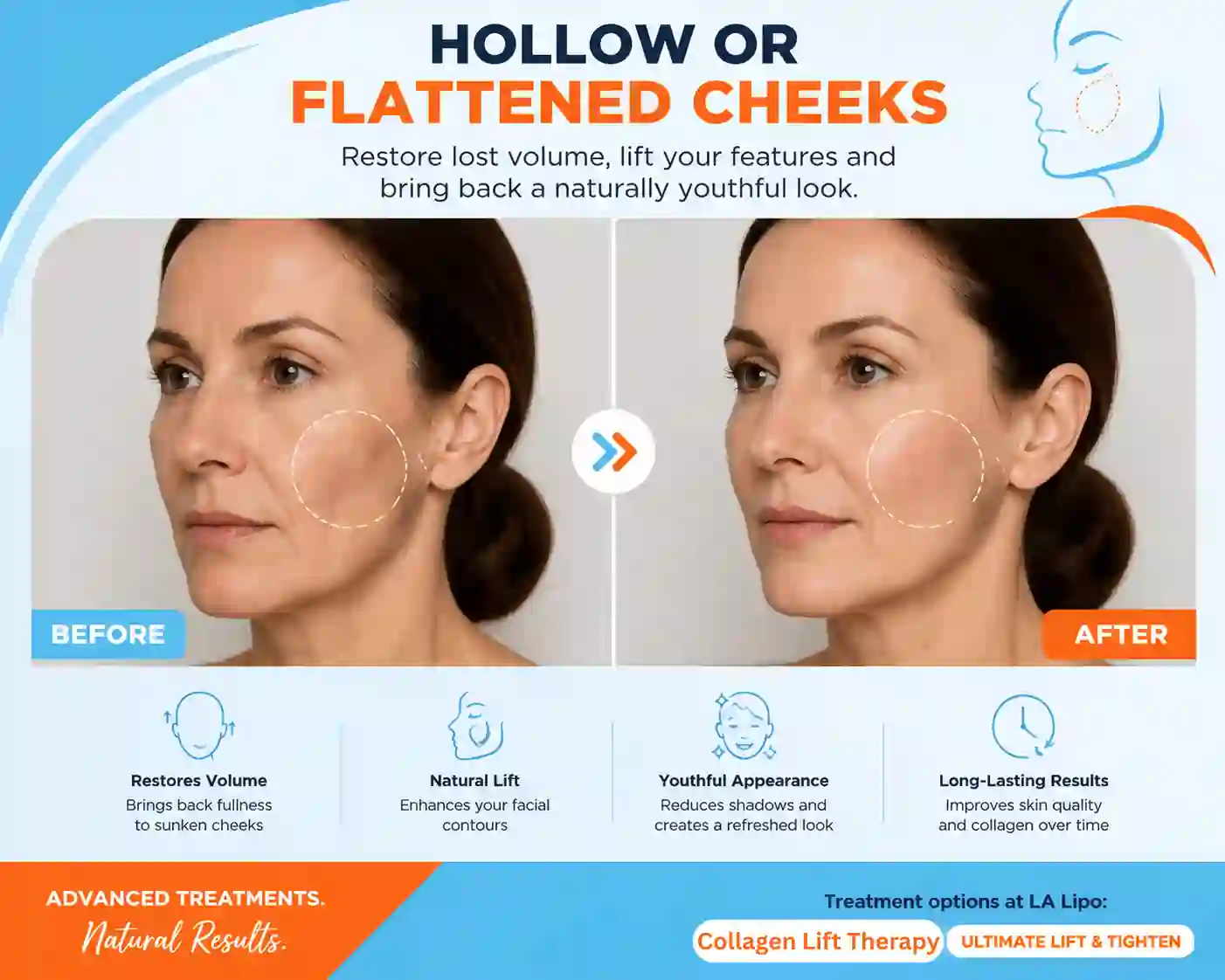 Sign #4: Hollow or Flattened Cheeks Edmonton