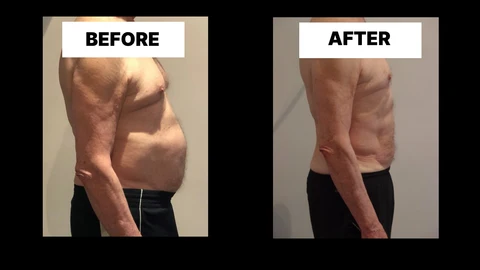 What Symptoms Can Diastasis Recti Cause in Men? Weak Core, Back Pain and Poor Posture Edmonton